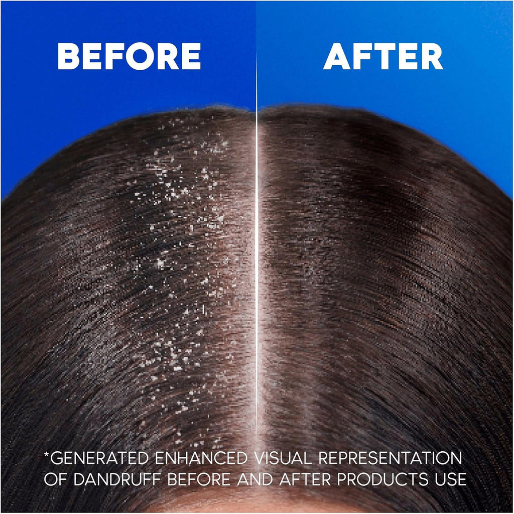 , Classic 2En1 Shampoing Et Après-Shampoing Antipelliculaire, Nettoie Et Hydrate Les Cheveux Et Le Cuir Chevelu, 1000 Ml