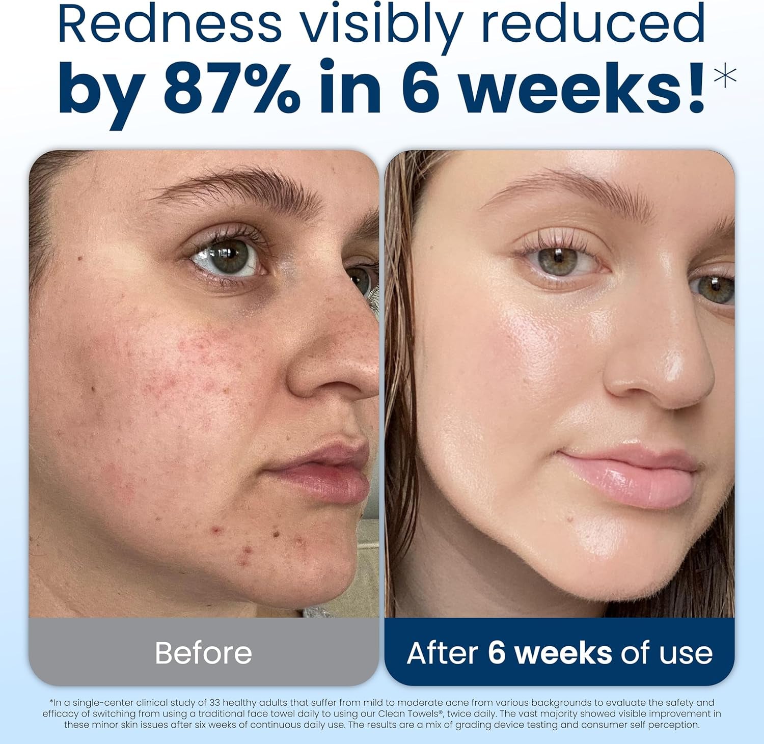 Serviettes Visage XL 100% Biologiques Certifiées USDA, Approuvées Par Les Dermatologues, Anti-Acné Serviettes Jetables Pour Le Visage Et Le Démaquillage, Ultra Douces