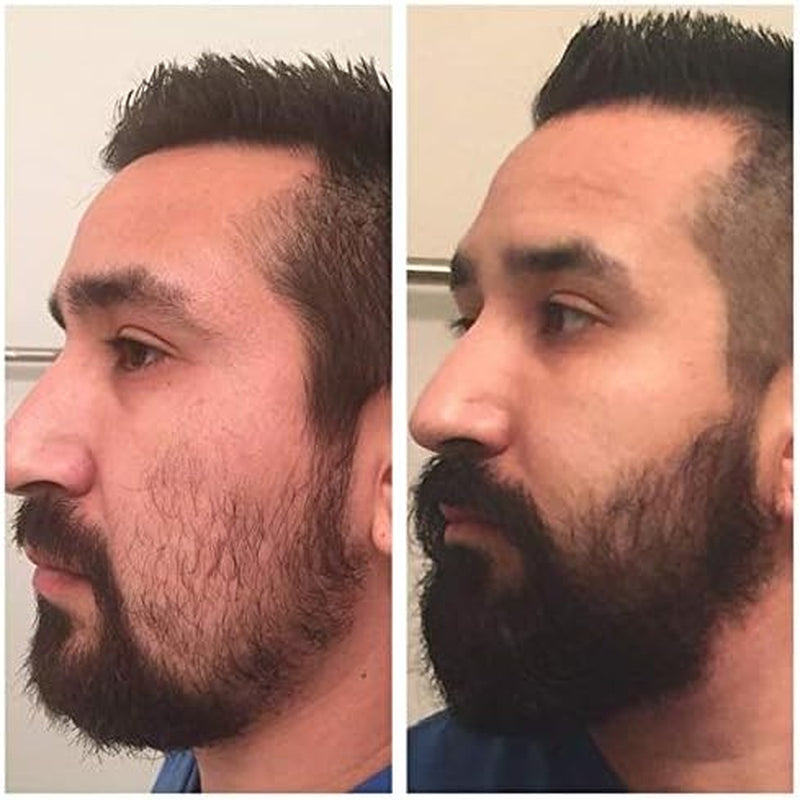 Ebeizi Derma Roller Pour La Croissance De La Barbe Avec Sérum De Croissance De La Barbe, Stimuler La Croissance De La Barbe Et Des Cheveux, Derma Roller De 0,5 Mm Pour Homme